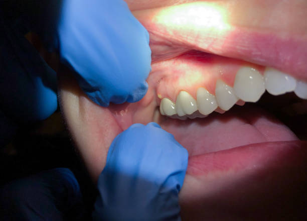 Best Knocked-Out Tooth (Avulsed Tooth) Treatment in Colmar Manor, MD